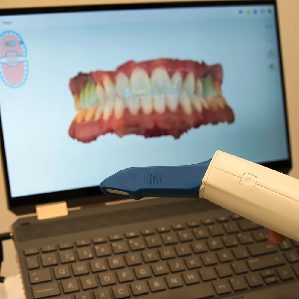 Escáner intraoral 3D en uso en la Clínica Dental Lobato de Elche para planificar la ortodoncia invisible